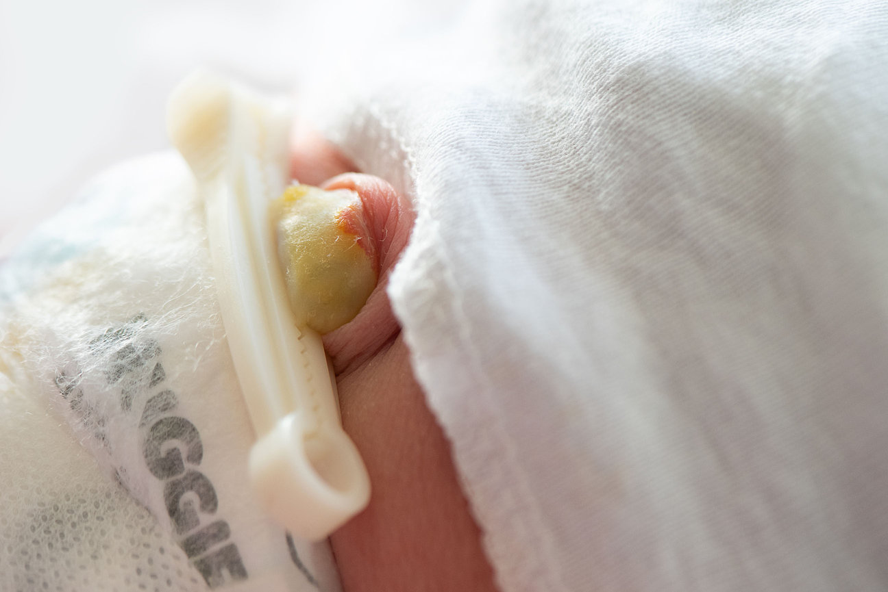 Close-up of a newborns healing belly button with a yellowish crust, partially covered by a white cloth. A plastic clamp is attached to the umbilical cord stump, typical shortly after birth, as observed at Northwestern Medicine Woodstock Hospital.